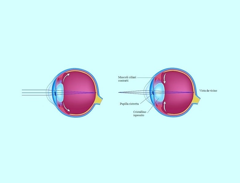 Presbiopia - Difetto visivo