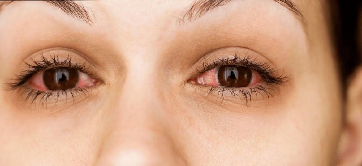 red-eye.jpg